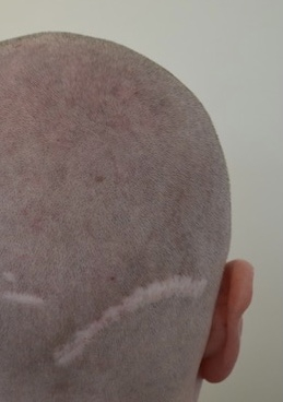 Are hair systems better than hair transplants?