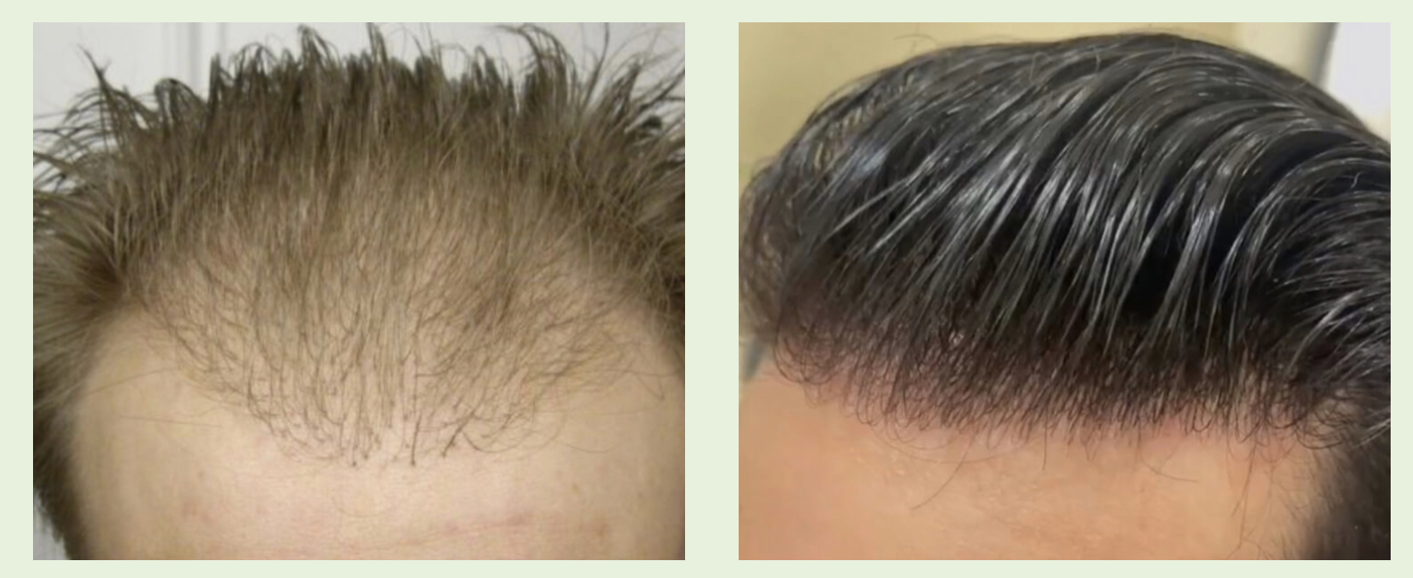 Are hair systems better than hair transplants?